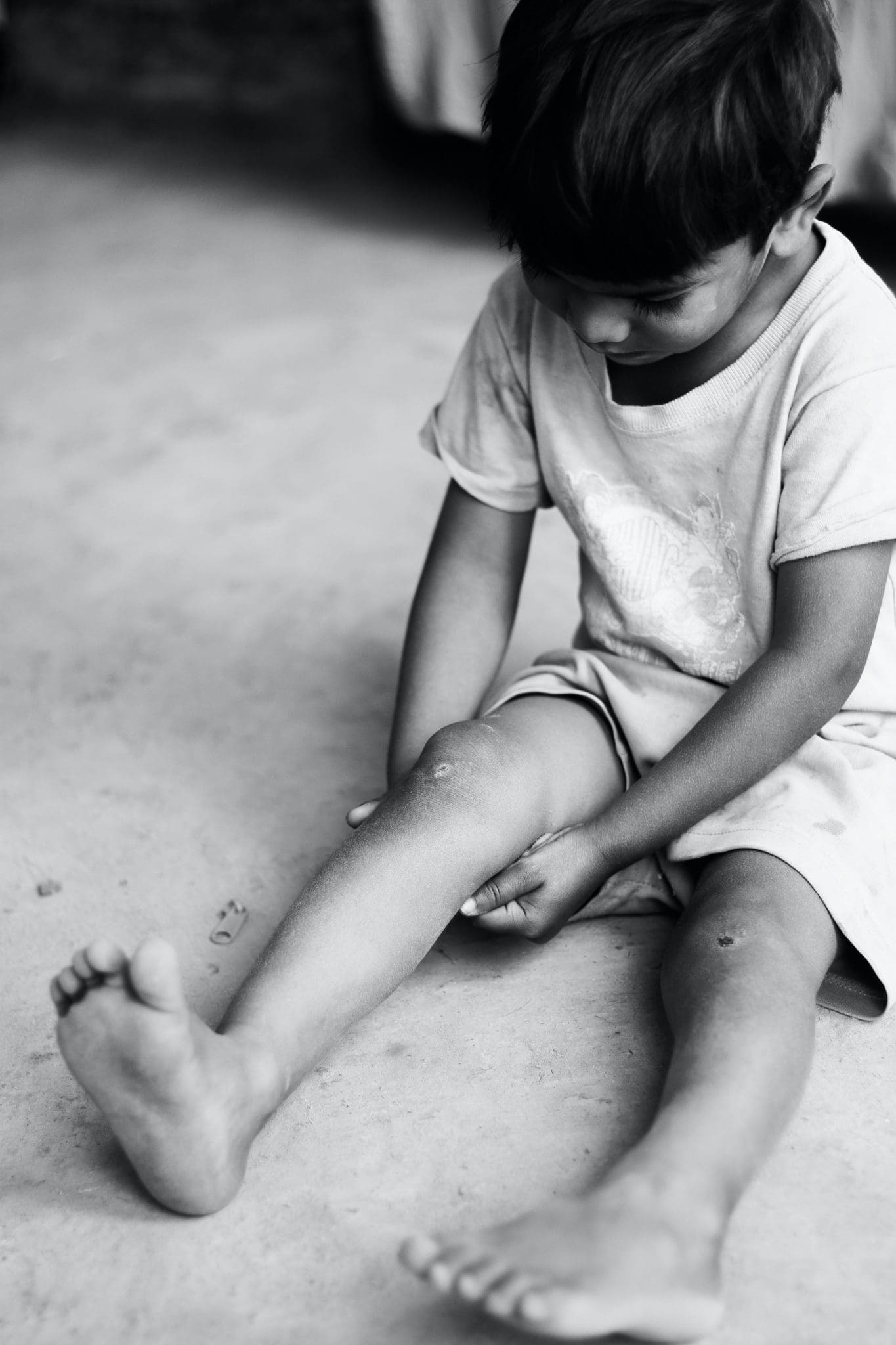 Boy with Scars